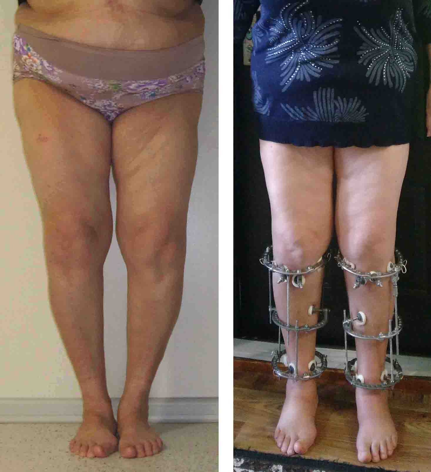 Пациентка 64 лет с гонартрозом 2-3 стадии. Слева - до операции, справа - через 2 месяца.