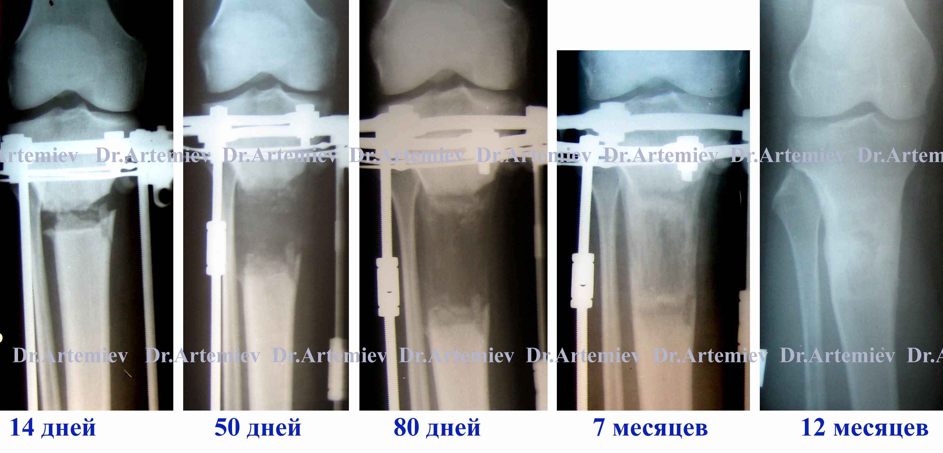 Регенерат большеберцовой кости в процессе удлинения голени на 7 см