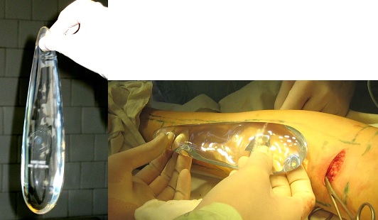 Внешний вид имплантата каплевидной формы на этапе установки