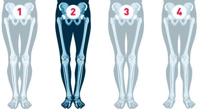 Х-образное искривление ног. Причины кривых ног и их коррекция