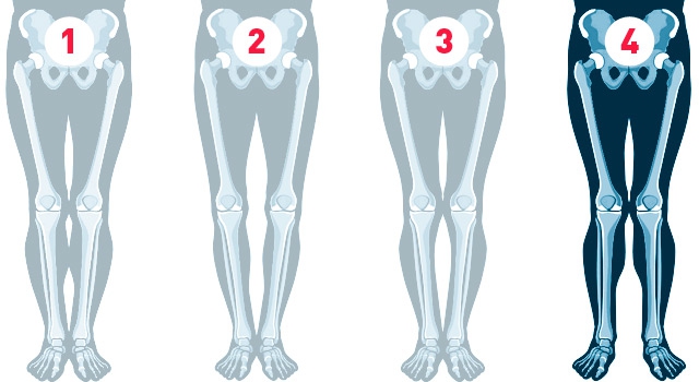 4 причины рекурвации коленного сустава - KinesioPro