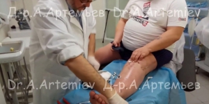 Видео доктора «Снятие аппарата Илизарова после коррекции голени»