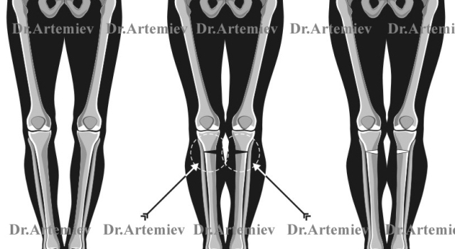 Схема высокой корригирующей остеотомии, направленной на восстановление нормального положения оси нижней конечности 