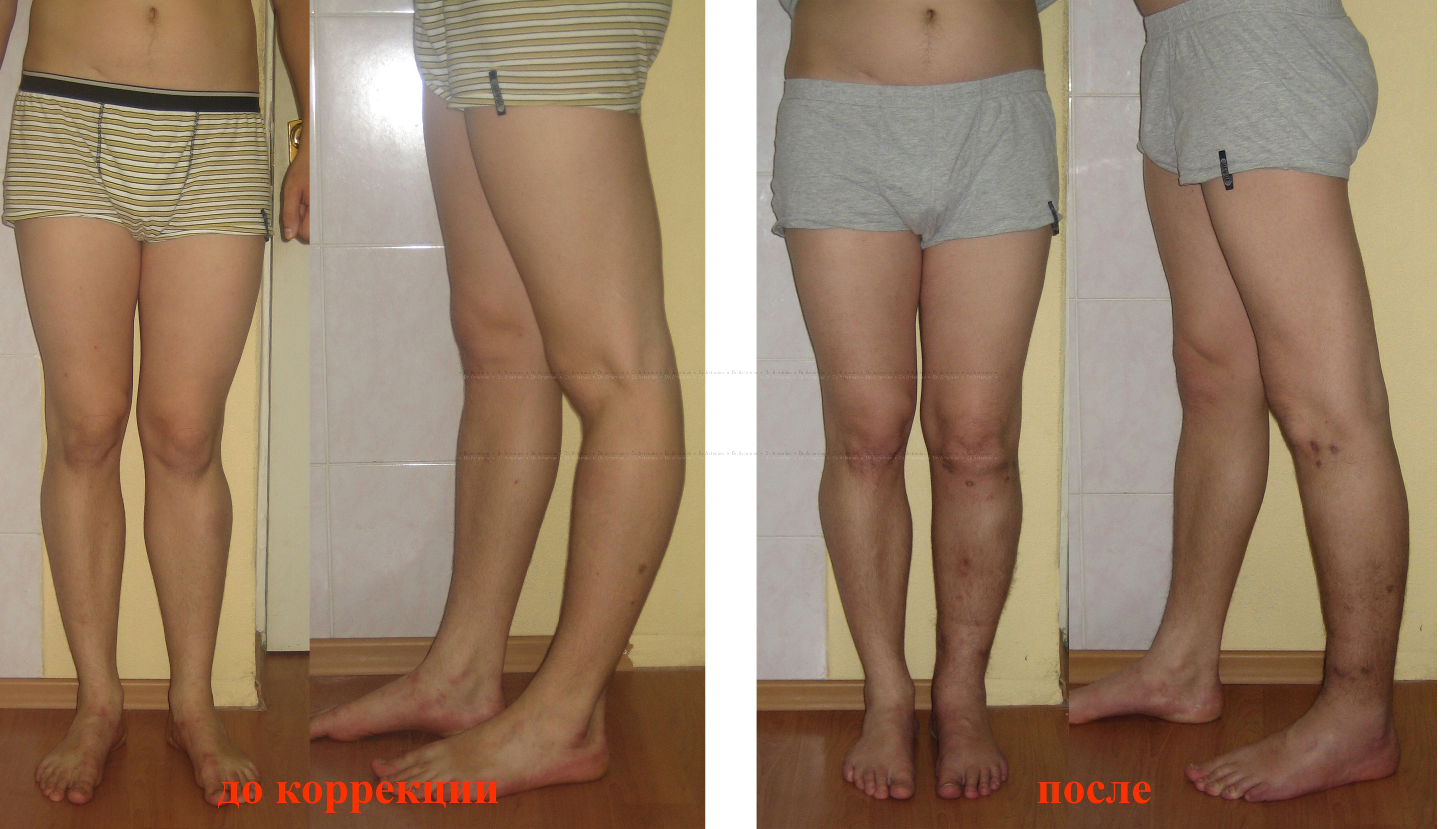 Причины деформации коленных суставов