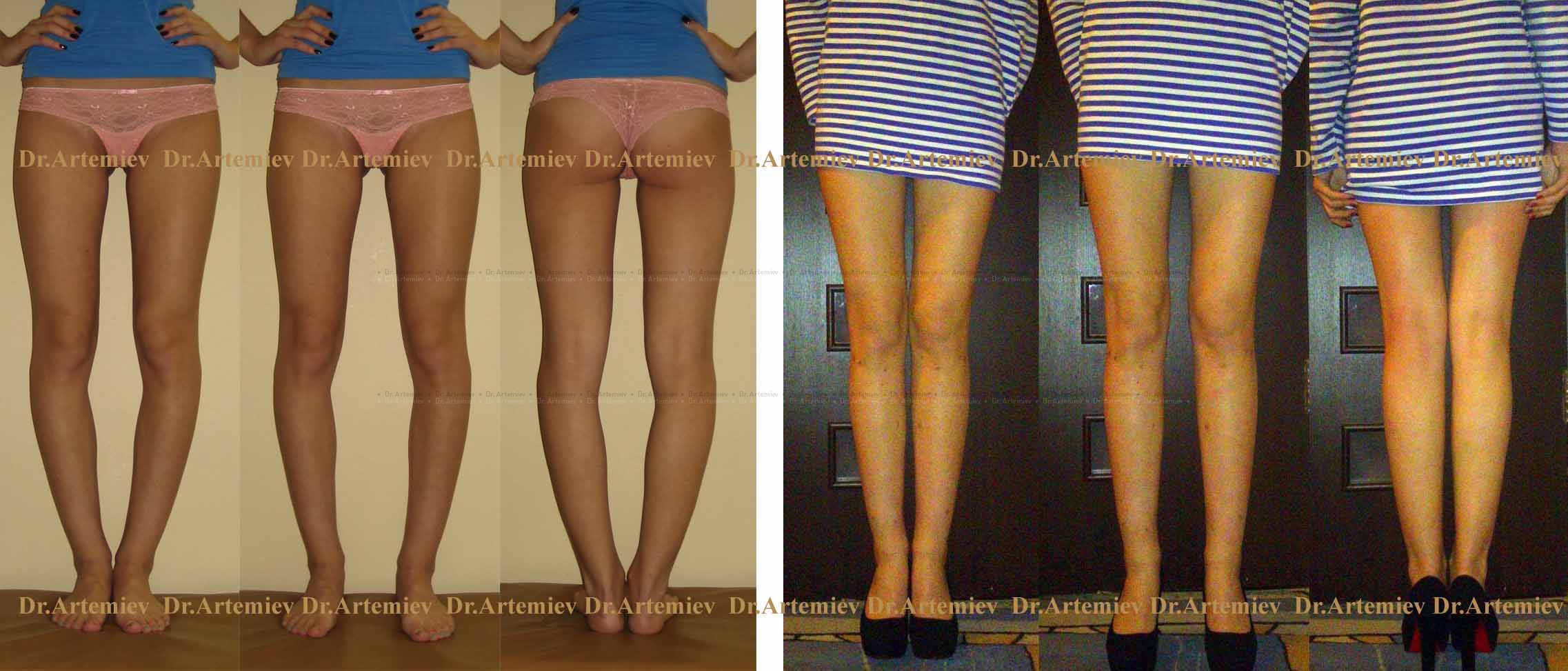 Причины деформации коленного сустава