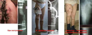 Лечение ложных суставов аппаратом илизарова