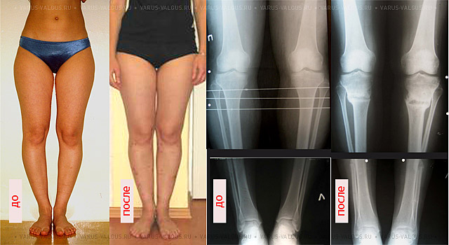 Внешний вид и рентгенограммы девушки 19 лет с эстетически неблагоприятным распределением мягких тканей на голени до и после угловой коррекции и медиализации