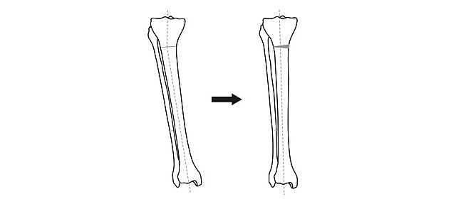 Схема исправления оси большеберцовой кости