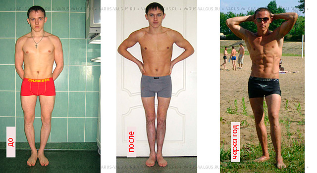 Мужчина до, через полгода и через год после комбинированной коррекции формы ног