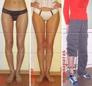 Варусная деформация ног у взрослых лечение