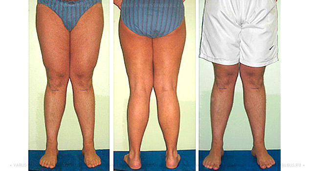 Внешний вид мужчины 38 лет с выраженной вальгусной деформацией ног до и после коррекции
