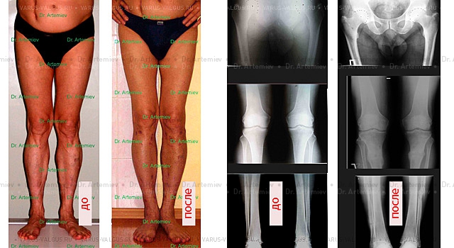 Внешний вид и рентгенограммы мужчины 56 лет с Х-образной формой ног до лечения и после коррекции (исправление формы ног   удлинение 4 см).