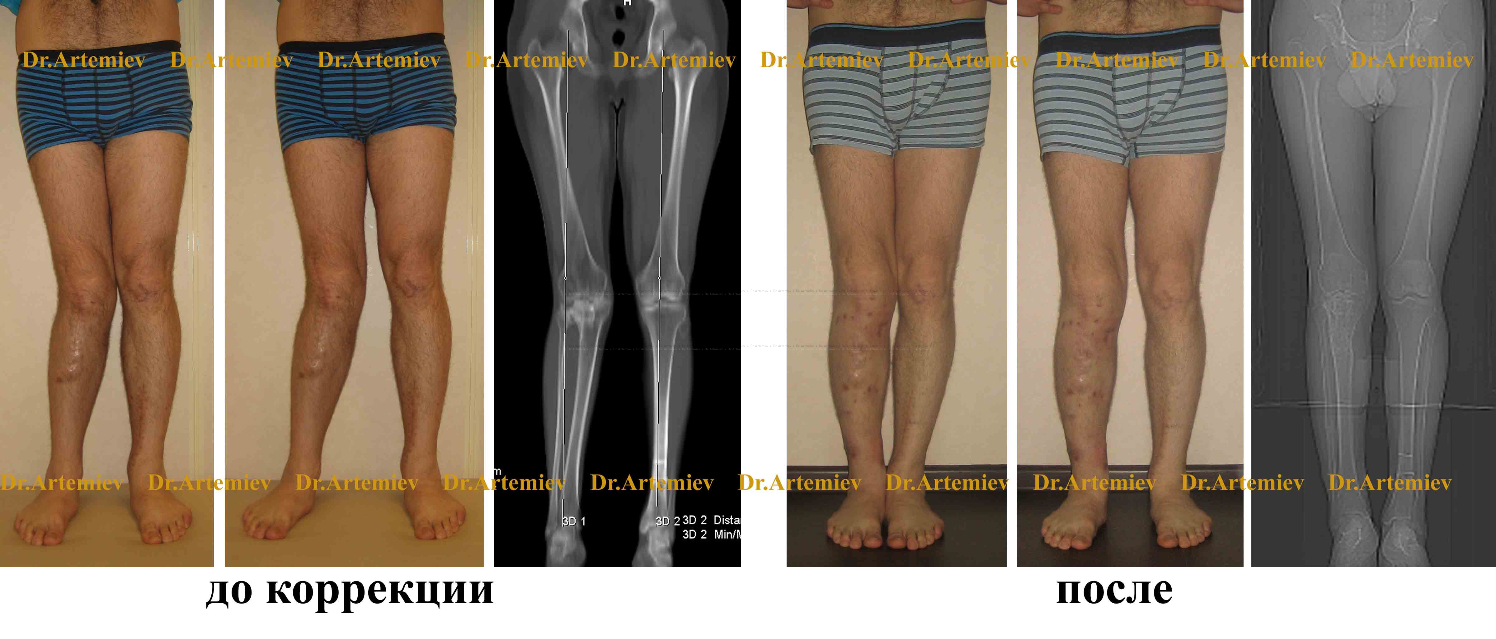 Варусная деформация коленных суставов операция