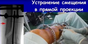 Видео доктора «Перелом голени. Аппарат Илизарова. 1 месяц после операции»