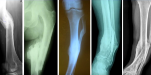 Видео доктора «Лечение неправильно сросшихся переломов конечностей»
