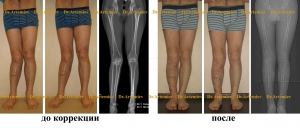 Иксообразные ноги у взрослых причины и лечение