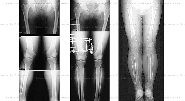 Рентгенограммы мужчины с вальгусной посттравматической деформацией правого бедра до операции, в процессе коррекции аппаратом Илизарова и после лечения