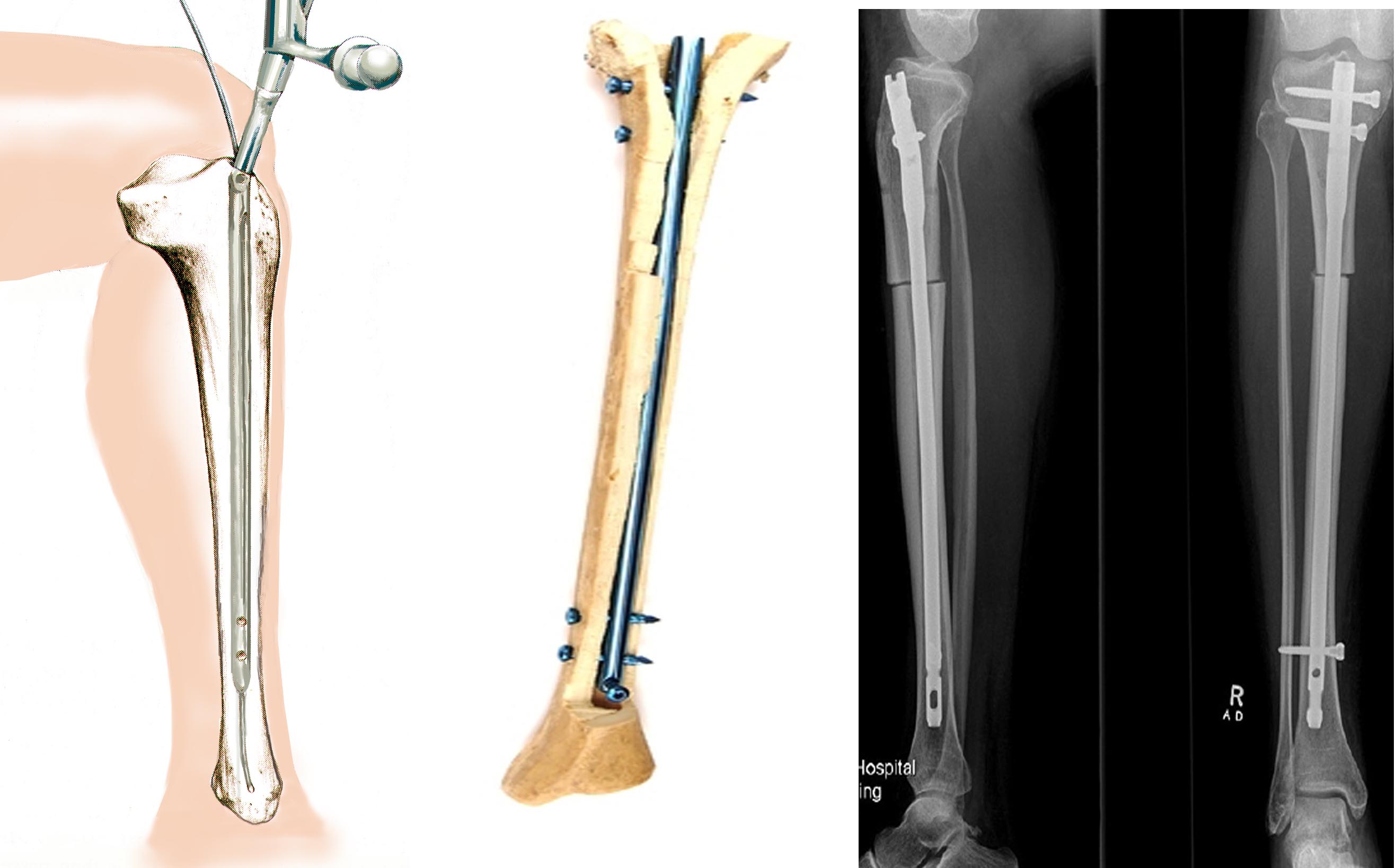 Схема введения, положение штифта внутри кости и рентгенограммы после операции