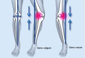 Артроз коленного сустава операция